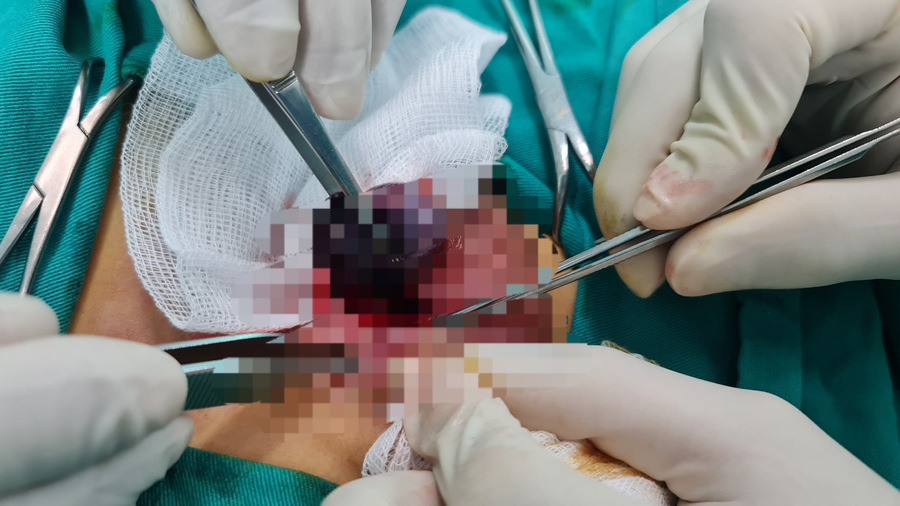 Số lượng ca bệnh nhập viện với chẩn đoán xoắn tinh hoàn tại Bệnh viện Nhi Thanh Hóa có chiều hướng tăng mạnh