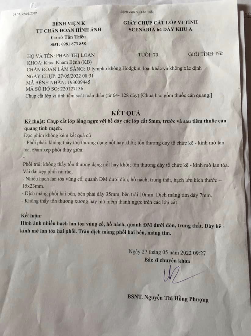 cu ba 72 tuoi u lympho ac tinh giai doan cuoi 1