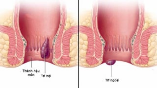 tri