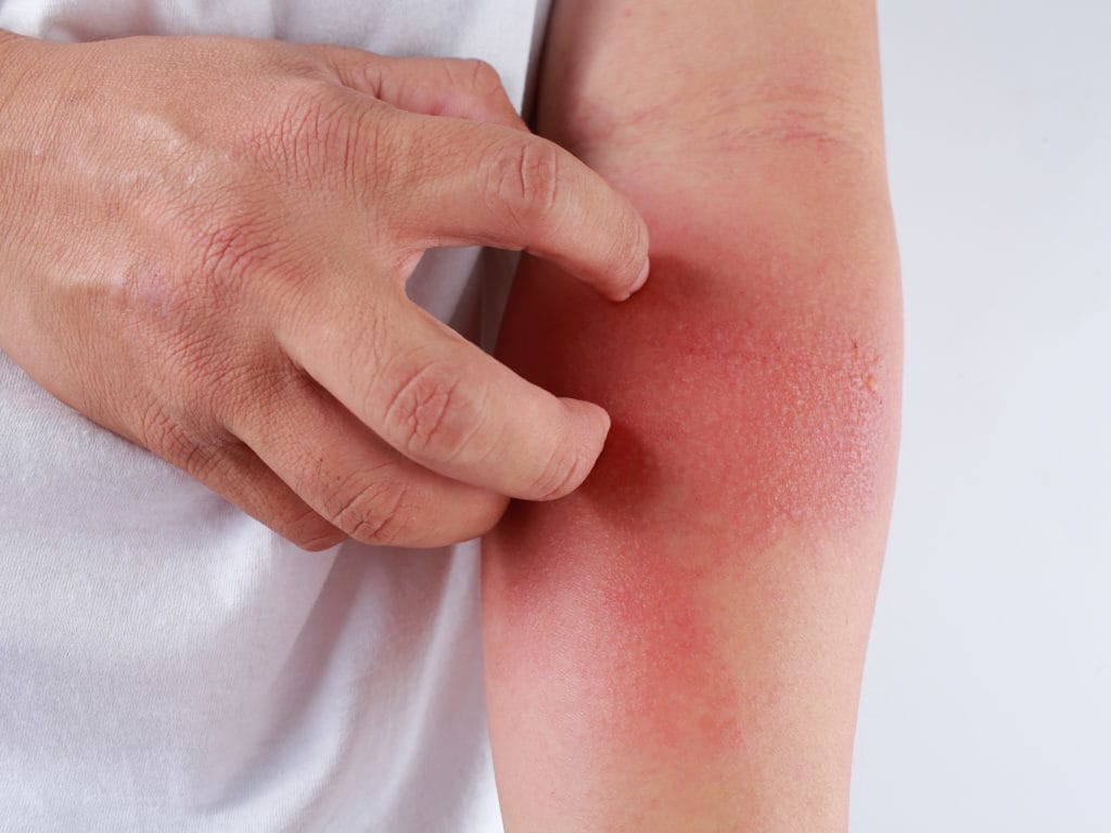 Ngứa dai dẳng ảnh hưởng đến chất lượng cuộc sống (Ảnh minh họa)