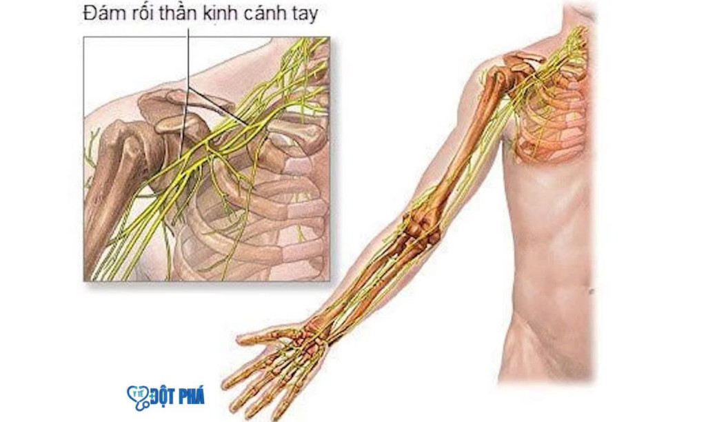 Đám rối thần kinh cánh tay (Ảnh chụp màn hình)