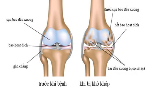 Khô khớp ở người trẻ xảy ra khi lớp sụn khớp bị thoái hóa (Ảnh minh họa)