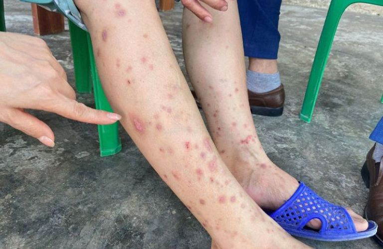 Những bệnh truyền nhiễm phổ biến trong mùa mưa lũ như: Tả, lỵ, thương hàn, tiêu chảy, đau mắt đỏ, sốt xuất huyết, viêm da, cảm cúm, viêm đường hô hấp…