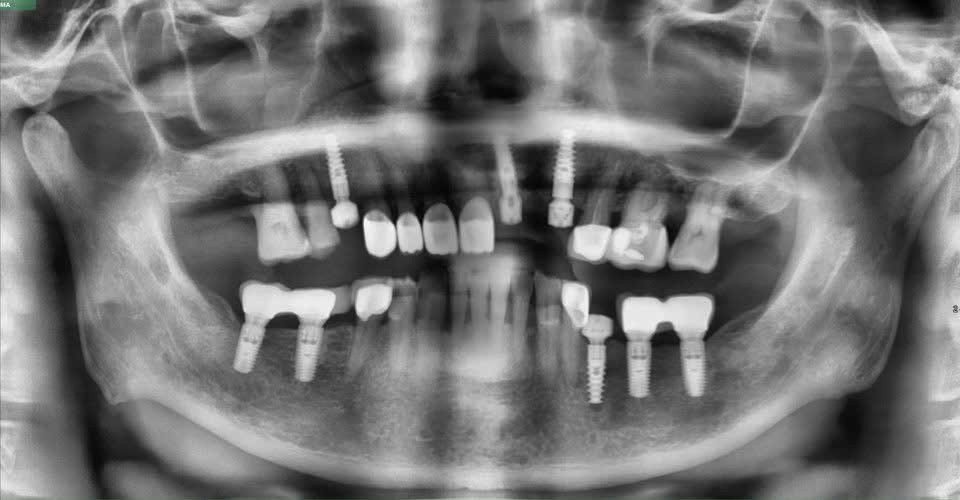 X-quang của một bệnh nhân đã thực hiện cấy ghép implant