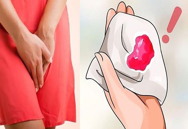 Bất kỳ hiện tượng xuất huyết ngoài kỳ kinh đều bất thường (Ảnh minh họa)