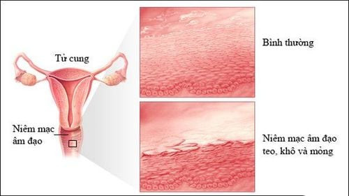 Hormone estrogen giảm làm cho mô âm đạo mỏng hơn, khô hơn, ít co giãn và yếu hơn (Ảnh minh họa)