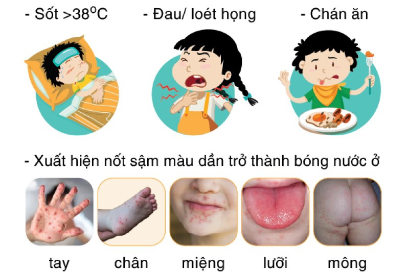 Cục Phòng bệnh (Bộ Y tế) có Công văn 1324/PB-BTN gửi Sở Y tế các tỉnh, thành phố về việc tăng cường công tác phòng chống bệnh Tay chân miệng