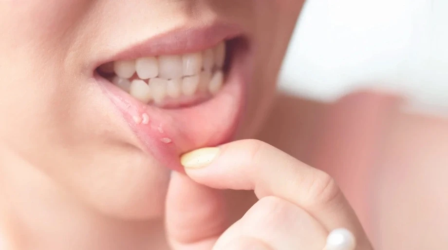 Loét miệng có thể là biểu hiện của thiếu magie (Ảnh minh họa)
