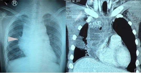 Hình ảnh U quái trung thất trong lồng ngực của bệnh nhân trẻ 