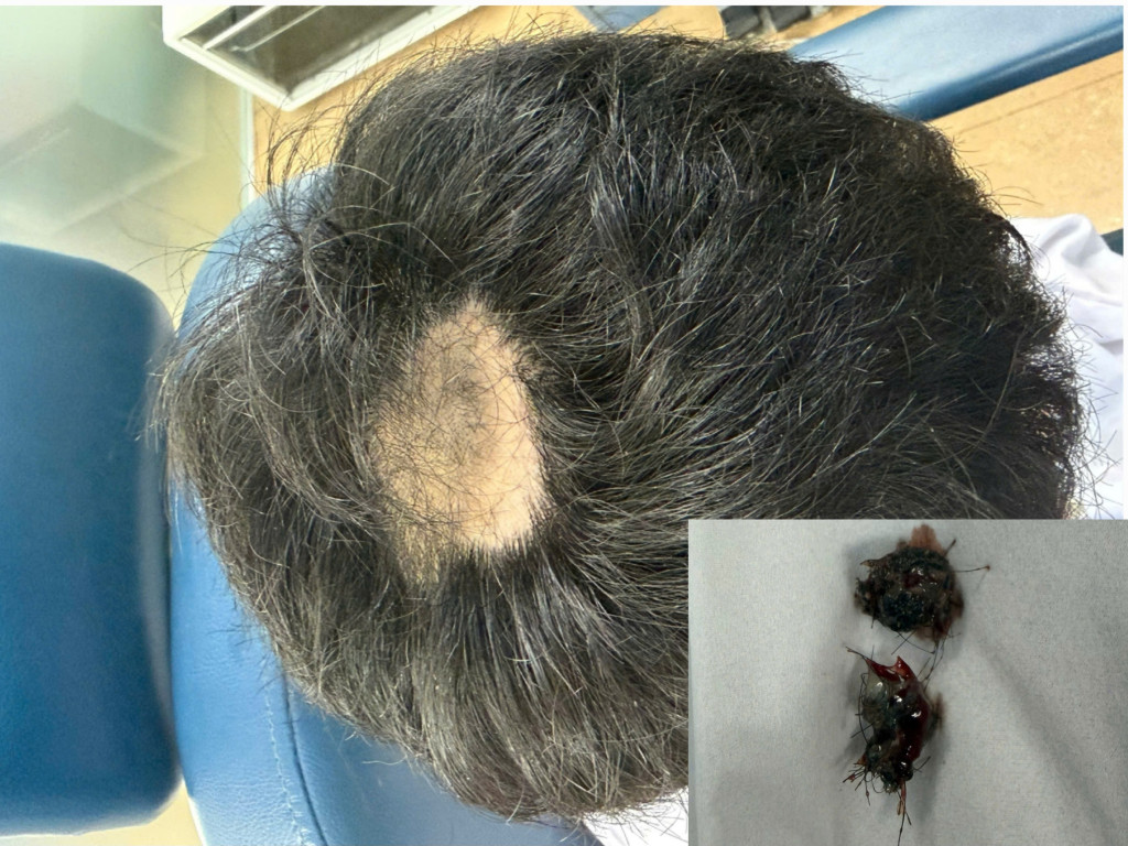 Nam sinh thường xuyên nhổ tóc của chính mình rồi vo tròn, nhét vào mũi