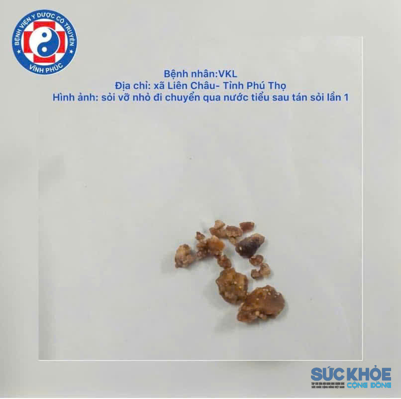 những viên sỏi được lấy ra từ phương pháp tán sỏi ngoài cơ thể 