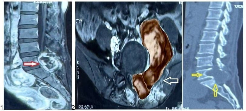 Hình ảnh chụp MRI và CT Scan trước phẫu thuật của bệnh nhân (Ảnh: Bệnh viện Bình Dân 115 TP. Hồ Chí Minh)