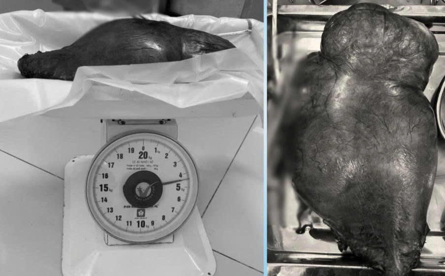 Sau phẫu thuật khối u xơ tử cung với trọng lượng 4,5kg đã được lấy ra khỏi cơ thể bệnh nhân (Ảnh: Bệnh viện Đa khoa Thủ Đức TP. Hồ Chí Minh)