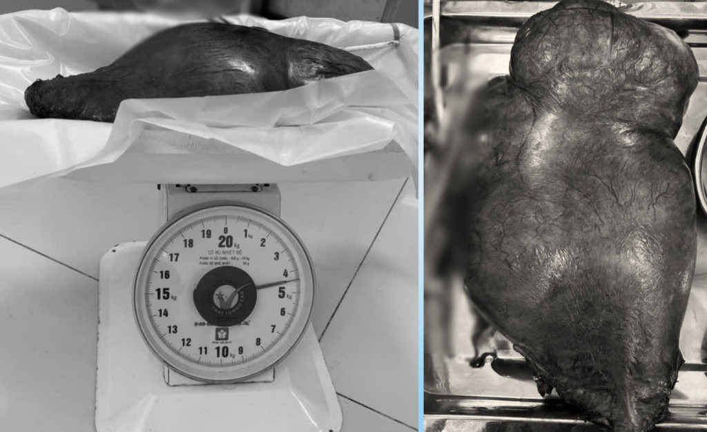 Khối u xơ tử cung có trọng lượng lên tới 4,5kg được bóc tách khỏi cơ thể bệnh nhân (Ảnh: BVCC)
