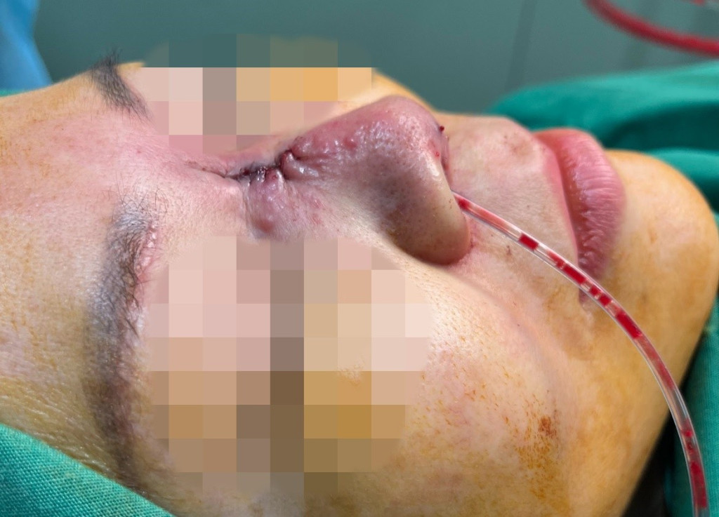 Vì mê tín người phụ nữ đã bị lừa nâng mũi đổi vận và thực hiện nhiều phương pháp làm đẹp dẫn đến biến chứng (Ảnh:BVCC)