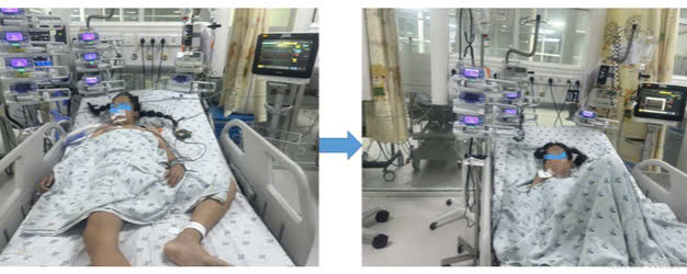Bé gái 11 tuổi đang được điều trị tích cực (Ảnh: Bệnh viện Nhi đồng Thành phố - TP. Hồ Chí Minh)