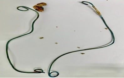 Thông jj được lấy ra khỏi cơ thể người phụ nữ 29 tuổi (Ảnh: Bệnh viện Nhân Dân 115 TP. Hồ Chí Minh)