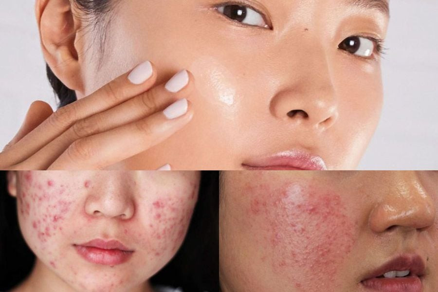 Chế độ ăn có ảnh gưởng phần lớn đến tình trạng da