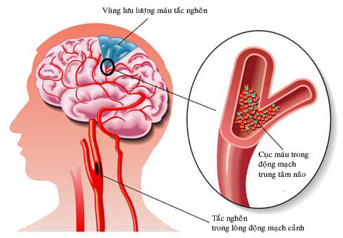 Rối loạn tiền đình có thể khởi phát bởi nhiều yếu tố khác nhau (Ảnh minh họa)