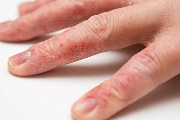 Môi trường ảnh hưởng đến sức khỏe da tay (Ảnh minh họa)