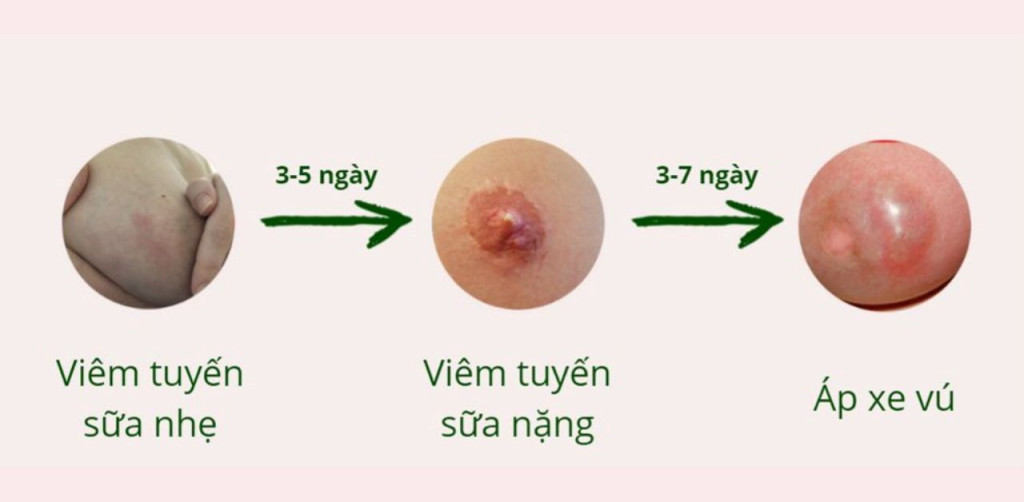 Tình trạng áp xe (Ảnh minh họa)