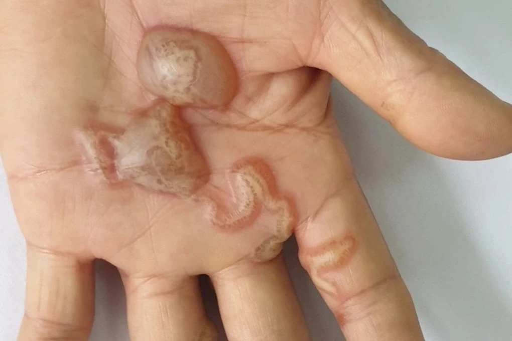 Bệnh do giun sán dễ xâm nhập cơ thể người khi môi trường sống không được đảm bảo (Ảnh minh họa)