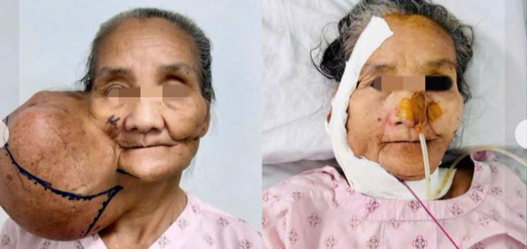 Bệnh nhân trước và sau khi được phẫu thuật tại Bệnh viện Trung ương Quân đội 108
