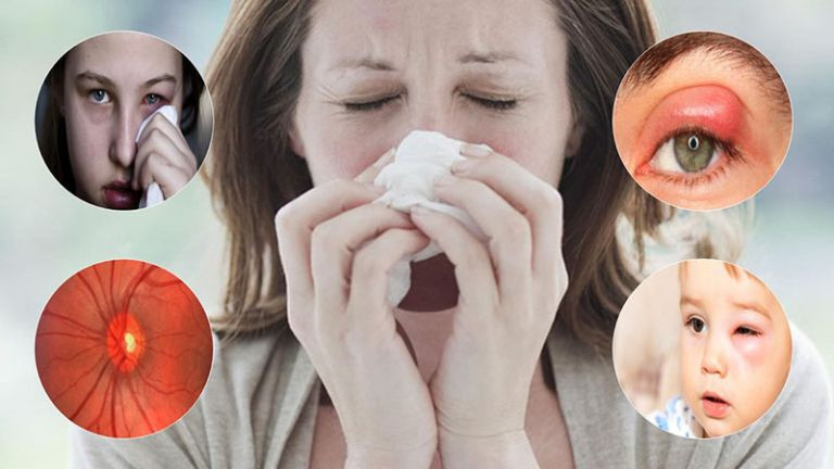 Viêm mũi dị ứng gây sưng mắt (Ảnh minh họa)