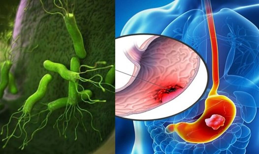 Viêm dạ dày ruột có các triệu chứng khác với viêm dạ dày (Ảnh minh họa)
