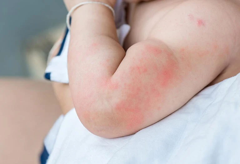 Trẻ dị ứng trứng có các biểu hiện như ngứa, nổi mề đay không thuộc nhóm chống chỉ định tiêm vắc xin cúm  (Ảnh minh họa)