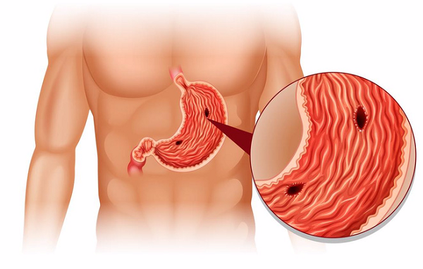 Loét dạ dày là nguyên nhân phổ biến nhất dẫn đến thủng dạ dày (Ảnh minh họa)