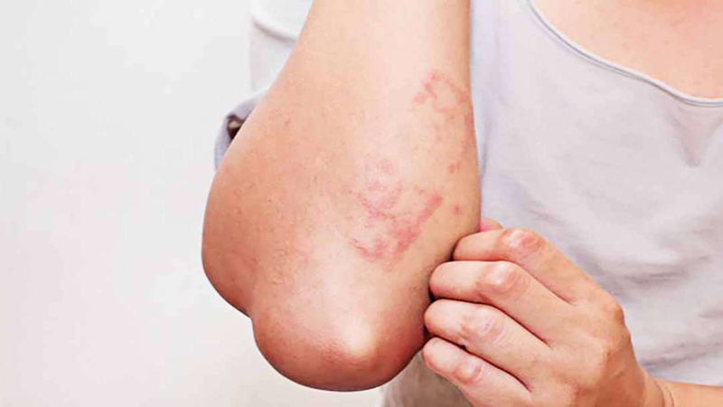 Biểu hiện của nhiễm giun sán qua da (Ảnh minh họa)