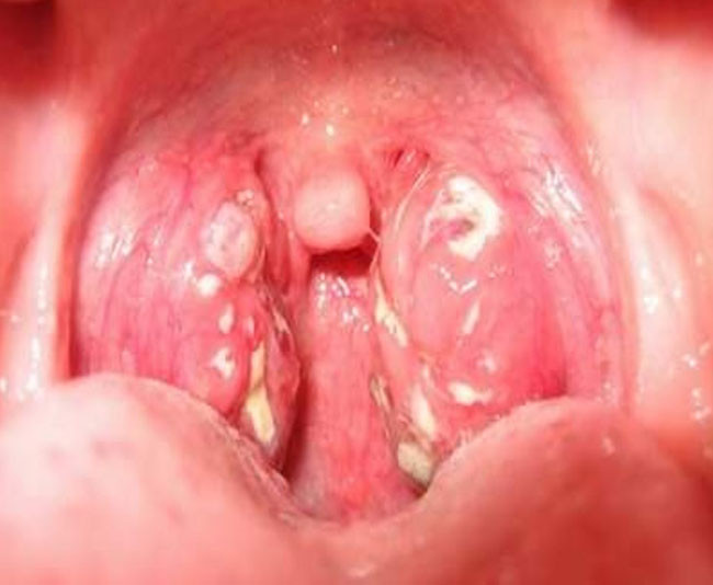 Viêm họng hạt ở trẻ em (Ảnh minh họa)