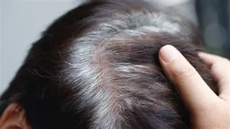 Hiện tượng tóc bạc xuất hiện khi cơ thể ngừng sản sinh melanin (Ảnh minh họa)