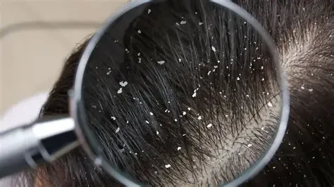 Nhiều người đã gội đầu nhưng vẫn gặp tình trạng gàu (Ảnh minh họa)