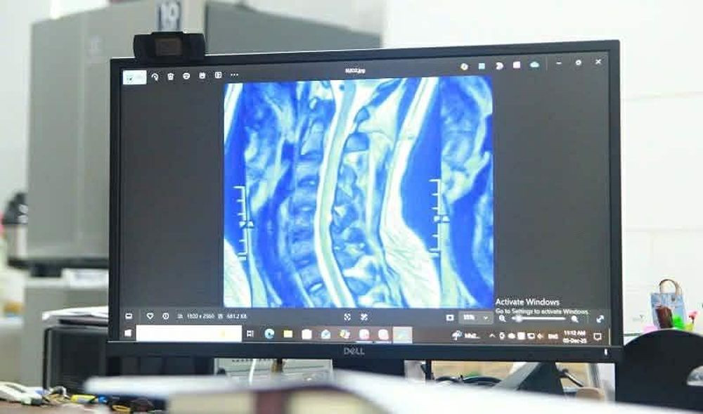 Hình ảnh tổn thương trên kết quả chụp của bệnh nhân ngộ độc NO2 do sử dụng bóng cười (Ảnh: BVCC)
