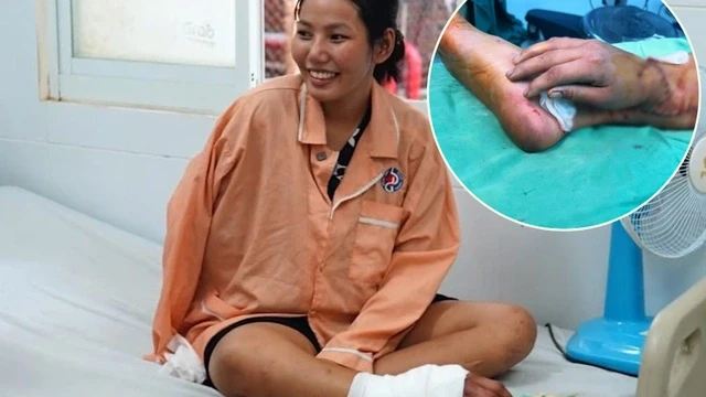 Sản phụ bị đứt lìa bàn tay sau tai nạn lao động được phẫu thuật cấy ghép 
