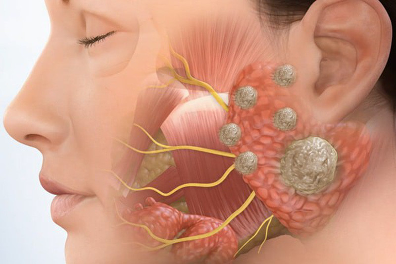U tuyến nước bọt (Ảnh minh họa)