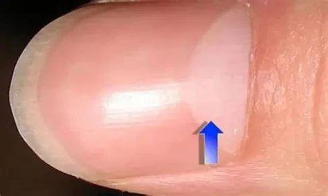 Tình trạng móng tay xuất hiện lưỡi liềm trắng khiến nhiều người lo lắng (Ảnh minh họa)