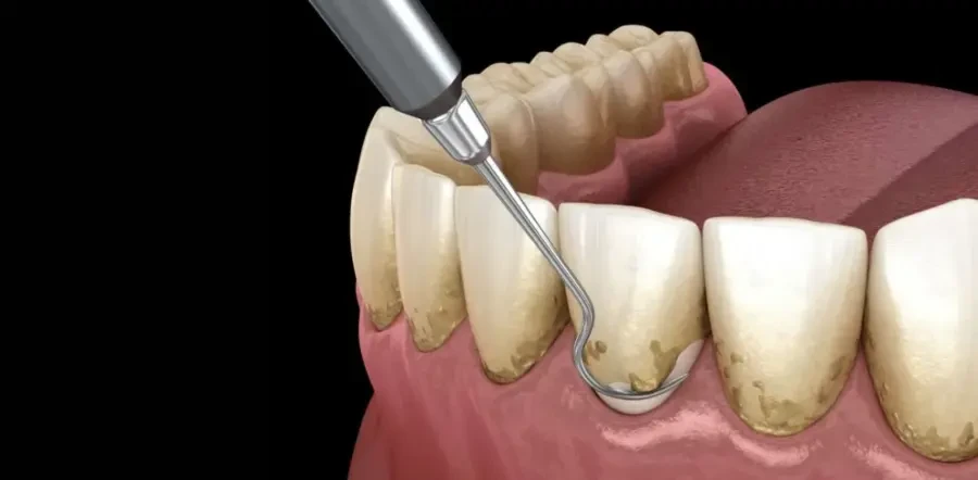 Nên vệ sinh răng miệng và lấy vôi răng thường xuyên (Ảnh minh họa)