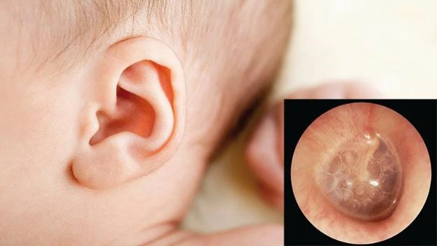 Viêm tai giữa tiết dịch ở trẻ (Ảnh minh họa)