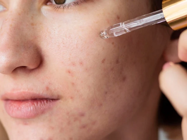 Retinol thúc đẩy quá trình bong sừng tự nhiên (Ảnh minh họa)