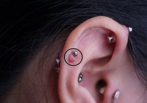 Sẹo lồi xuất hiện sau bấm lỗ tai do quá trình lành thương diễn ra bất thường (Ảnh minh họa)
