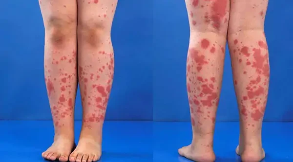 Nếu không được điều trị kịp thời có thể gây nguy hiểm tính mạng (Ảnh minh họa)