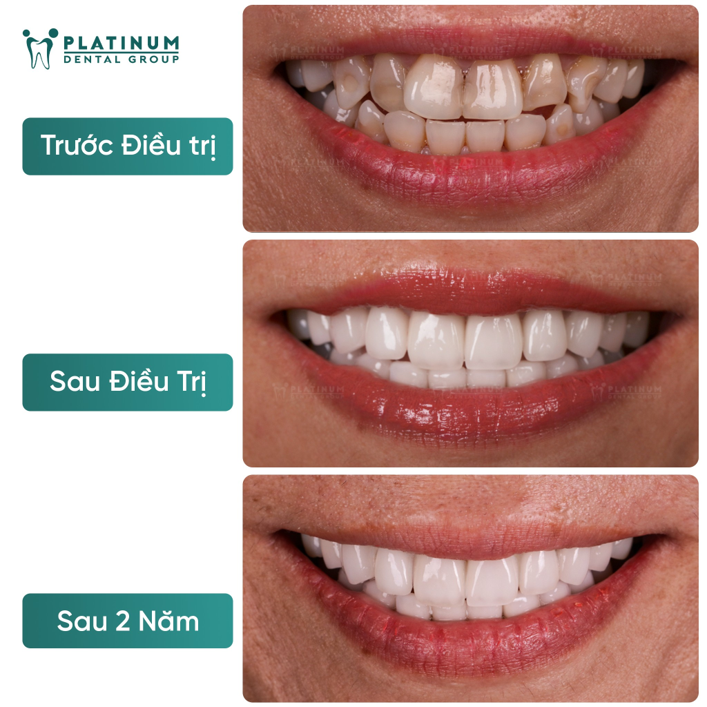 Trường hợp răng xỉn màu nặng và có bệnh lý, bọc răng sứ là giải pháp phù hợp 