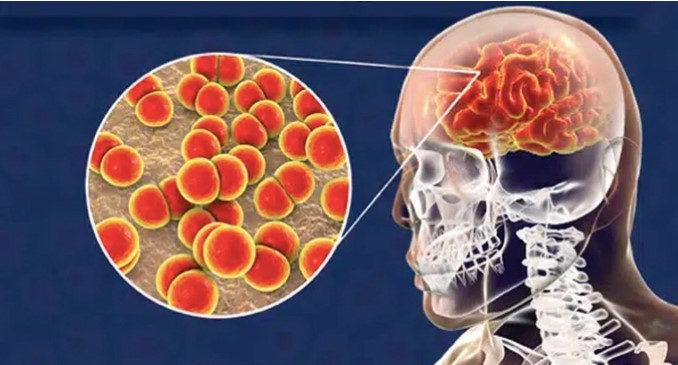 Não mô cầu là bệnh do vi khuẩn Neisseria meningitidis gây ra (Ảnh: Getty)