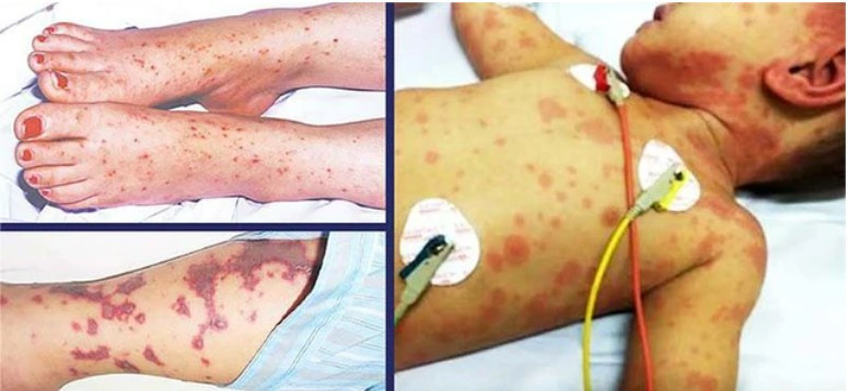 Trẻ em là đối tượng dễ mắc não mô cầu (Ảnh: TL)