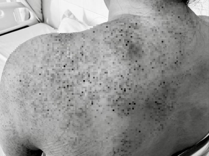 Người phụ nữ bị các triệu chứng bất thường sau khi chích lể, giác hơi (Ảnh: BVCC)