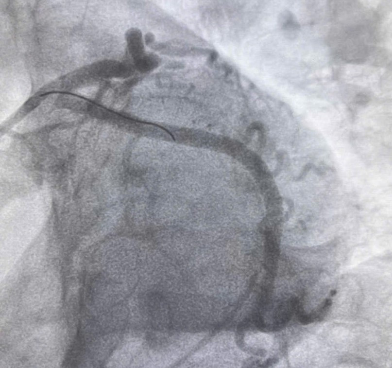 Hình ảnh động mạch vành của bệnh nhân sau đặt stent ( Ảnh T.D)