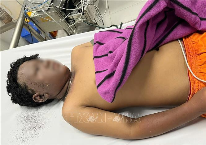 Bé trai 13 tuổi bị bỏng toàn bộ khuôn mặt do đốt pháo. Ảnh: TTXVN phát